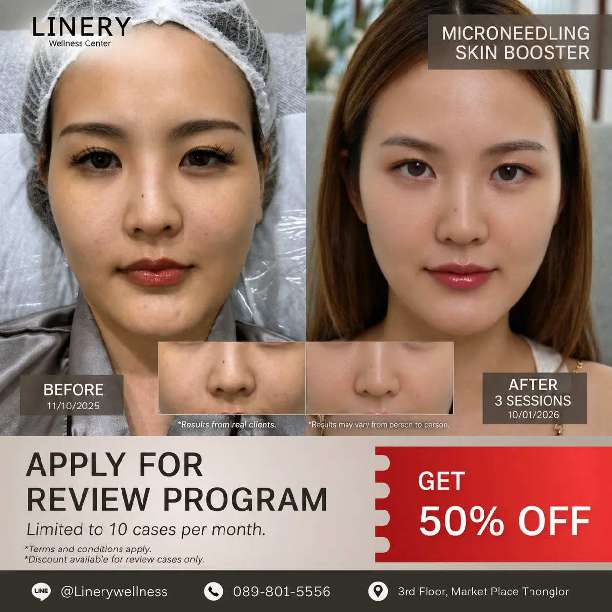 Microneedling Skin Booster promotion