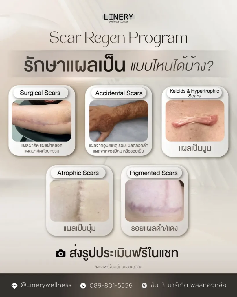 Scar Regen รักษาแผลแบบไหน