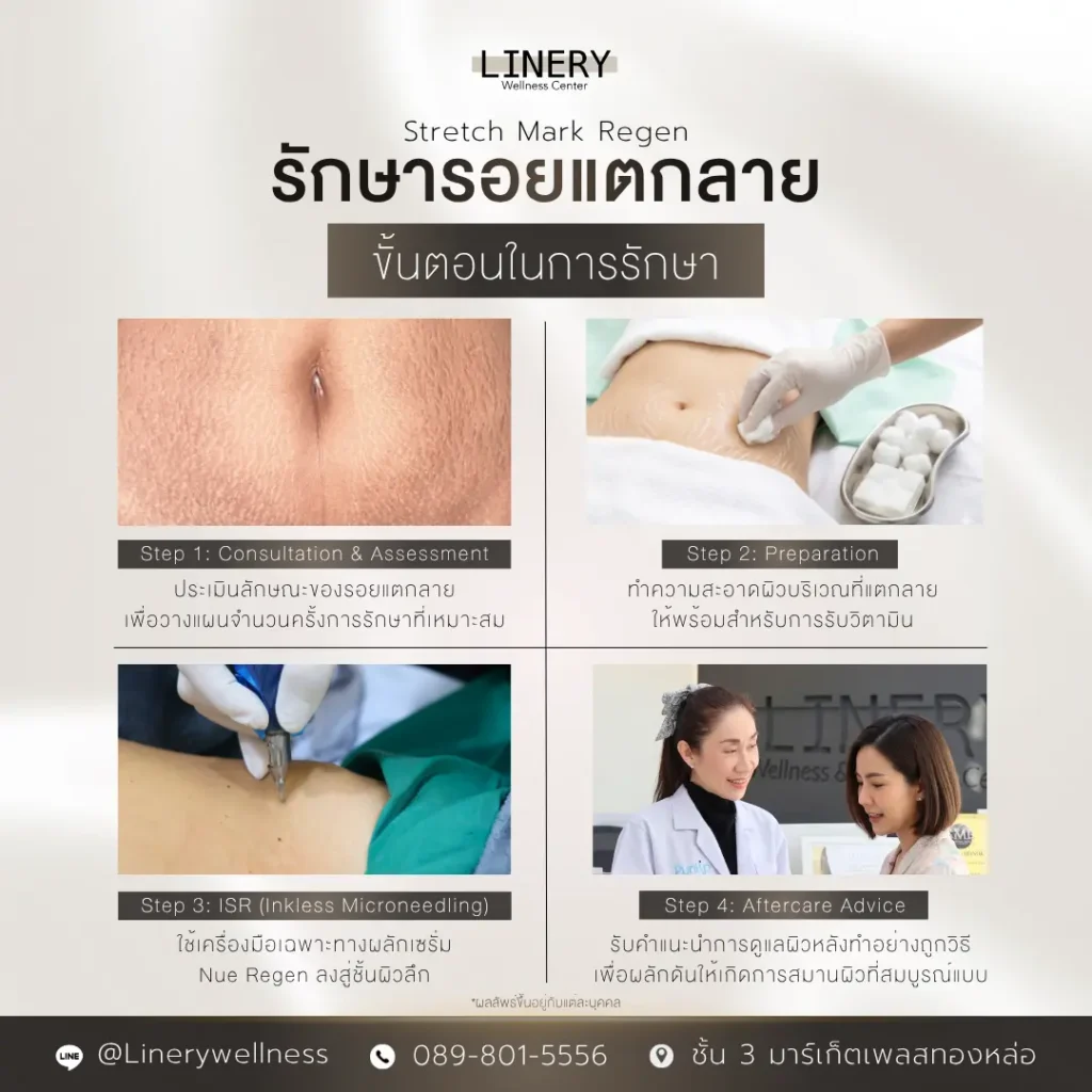 ขั้นตอนการรักษารอยแตกลาย
