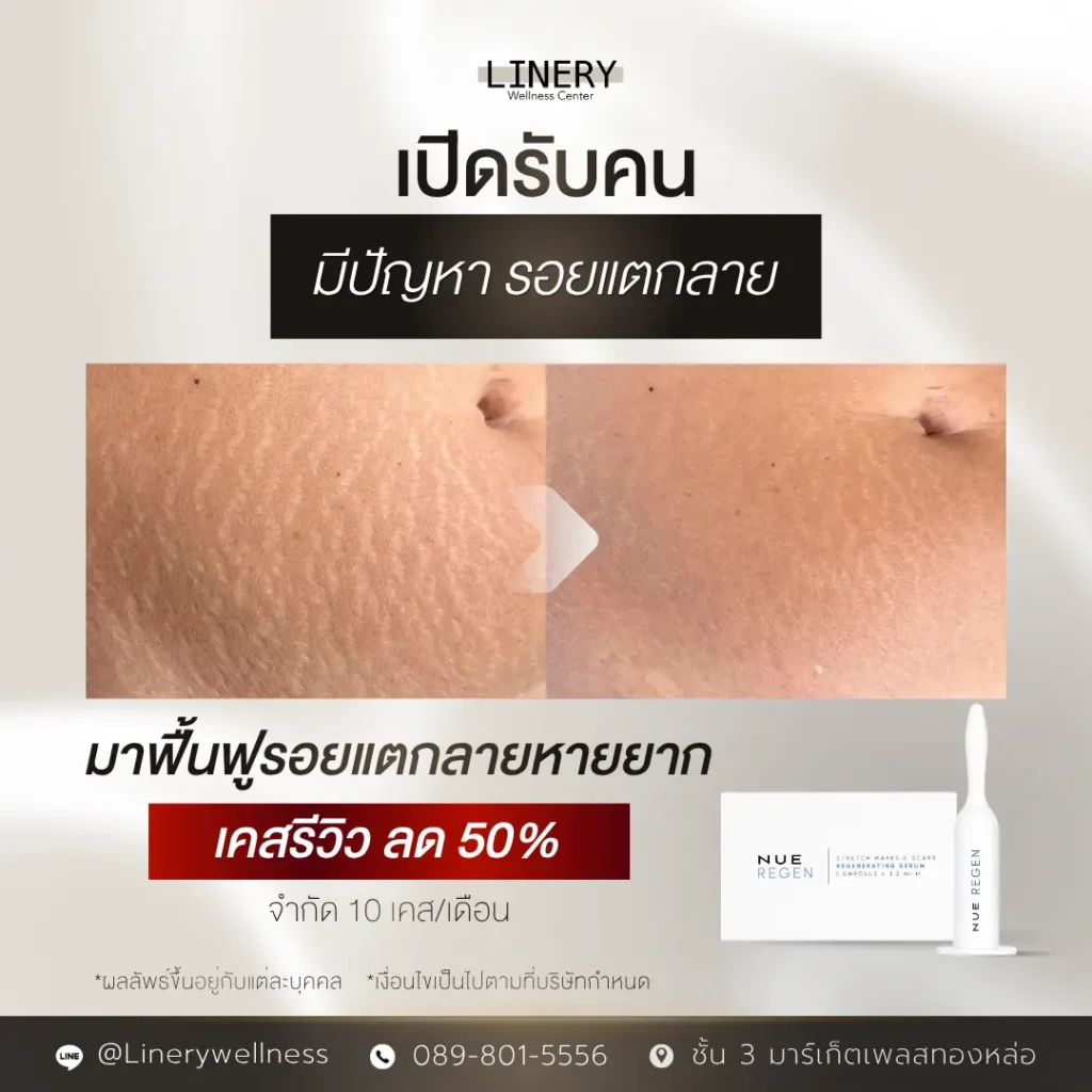 รอยแตกลาย โปรโมชัน