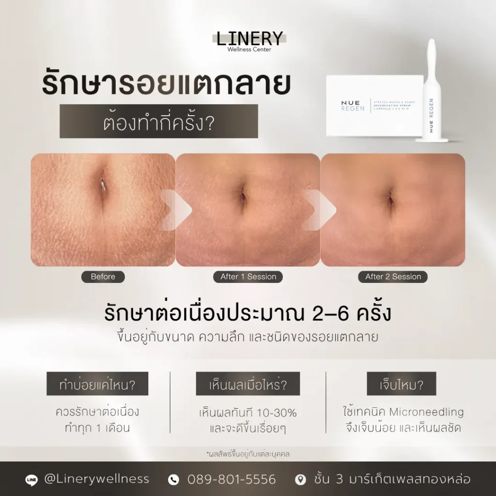 รักษารอยแตกลายต้องทำกี่ครั้ง