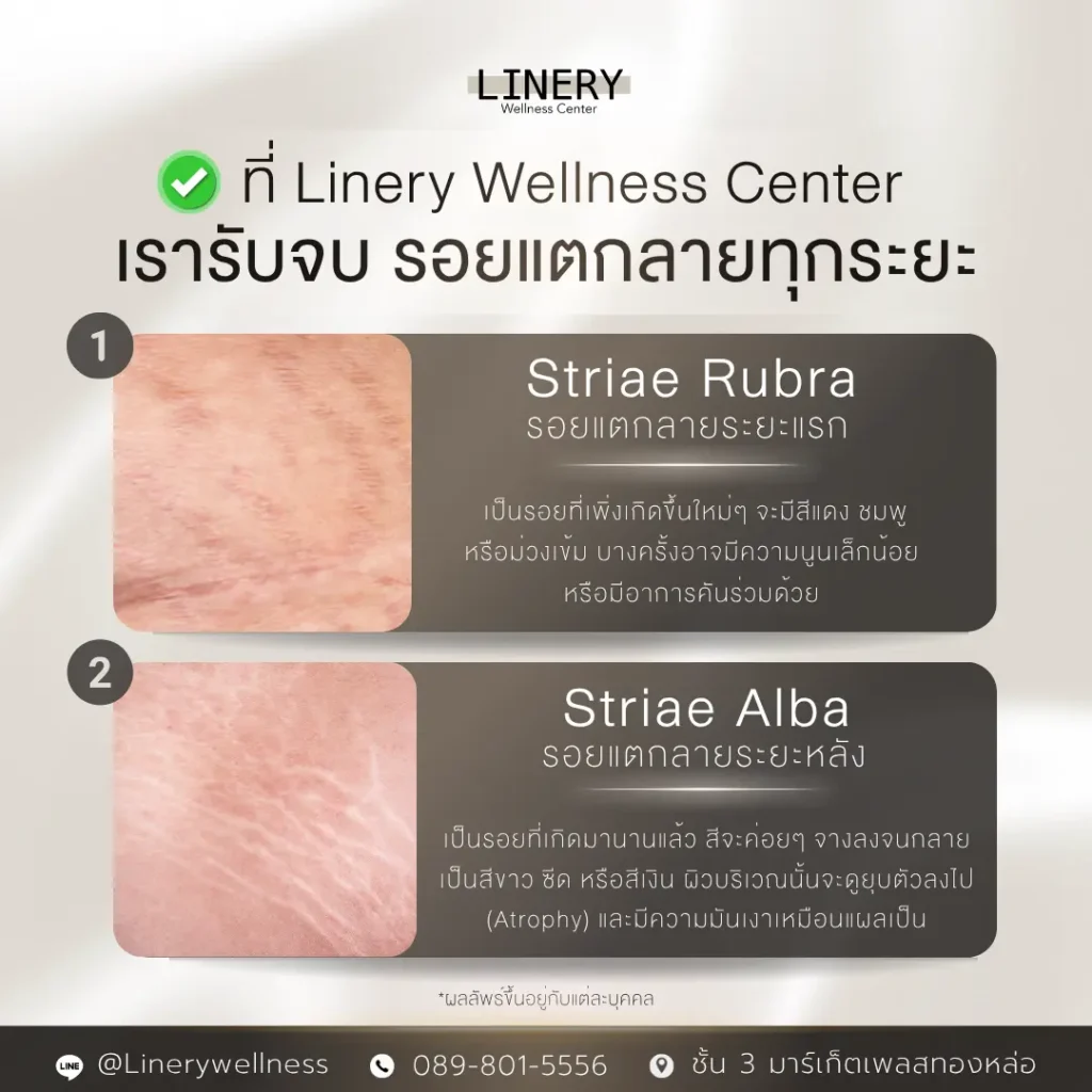 รักษารอยแตกลายที่ linery clinic