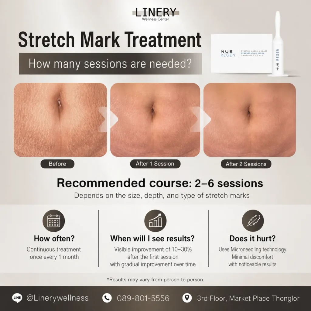 Stretch Mark Regen how many sessions