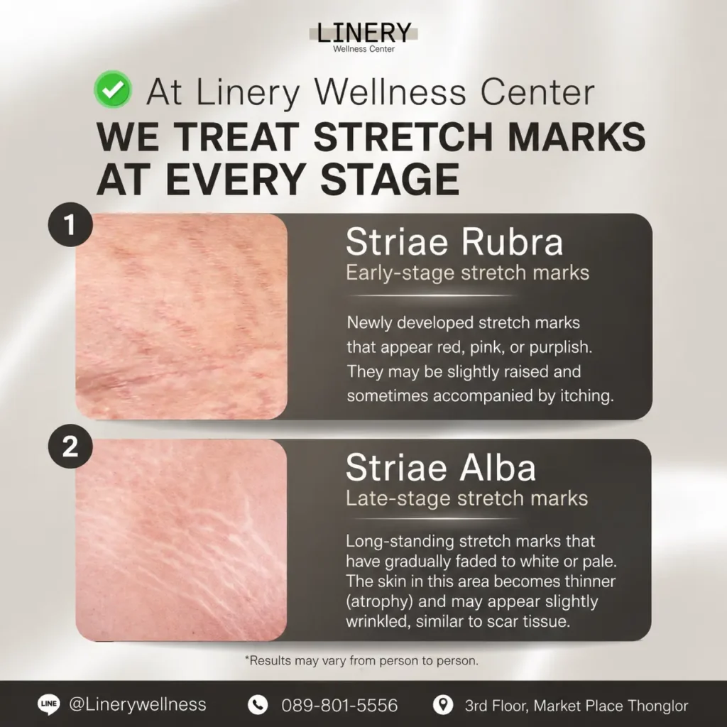 Stretch Mark Regen stage