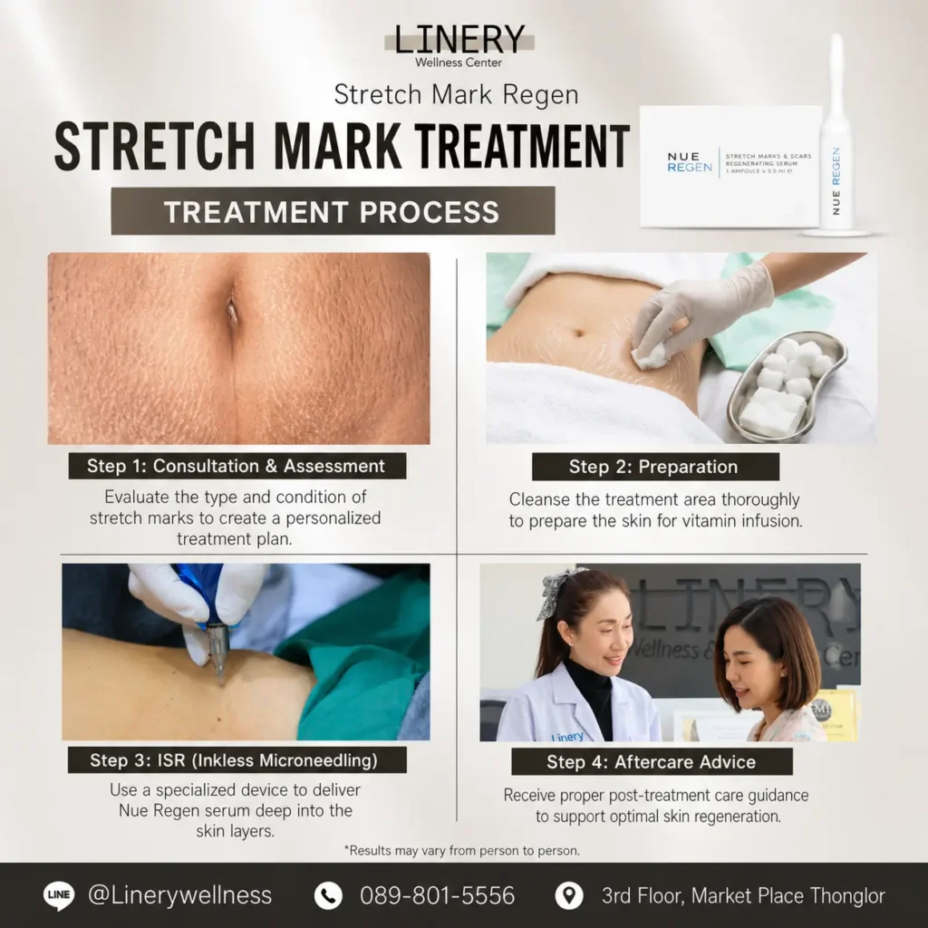 Stretch Mark Regen treatment
