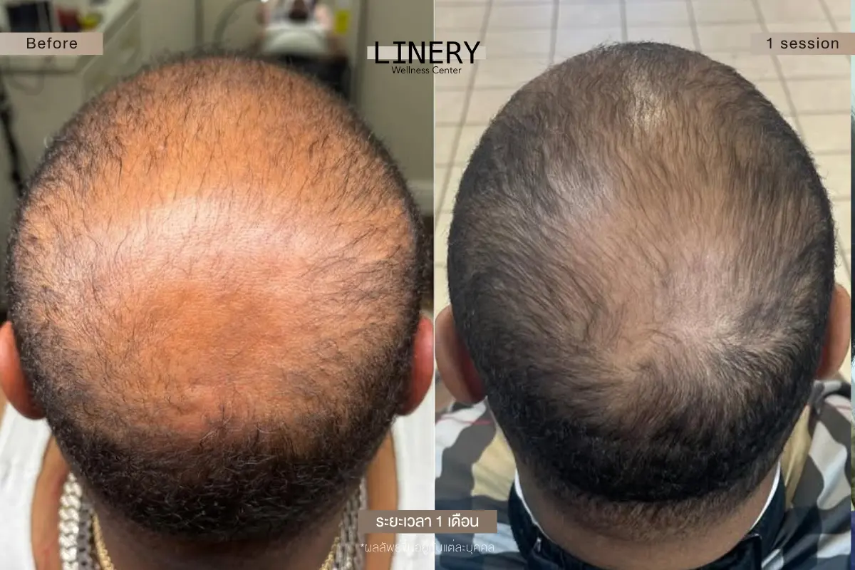 ผมบางกลางหัว crown hair thinning