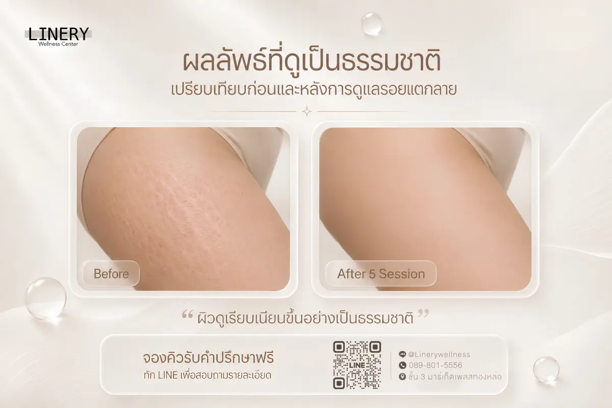 รีวิวรักษารอยแตกลายที่ขา ที่ linery