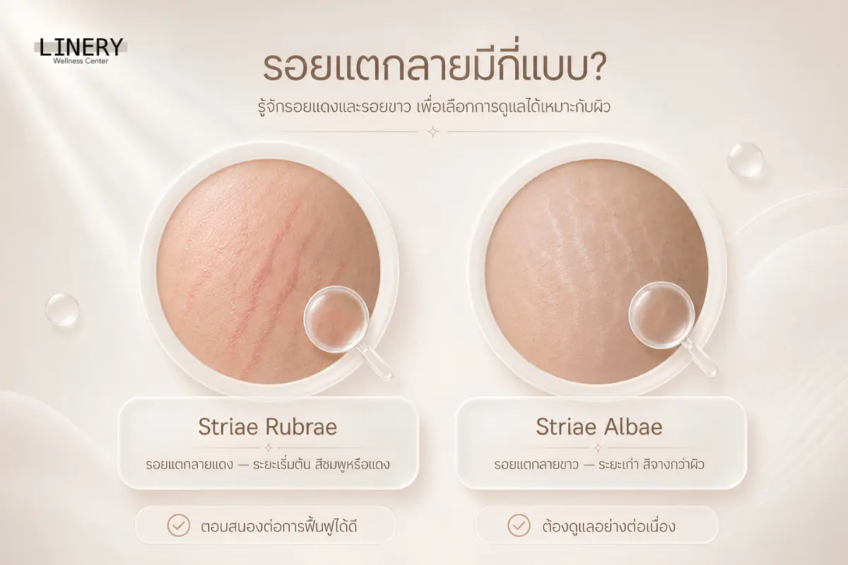 รอยแตกลายมีกี่แบบ