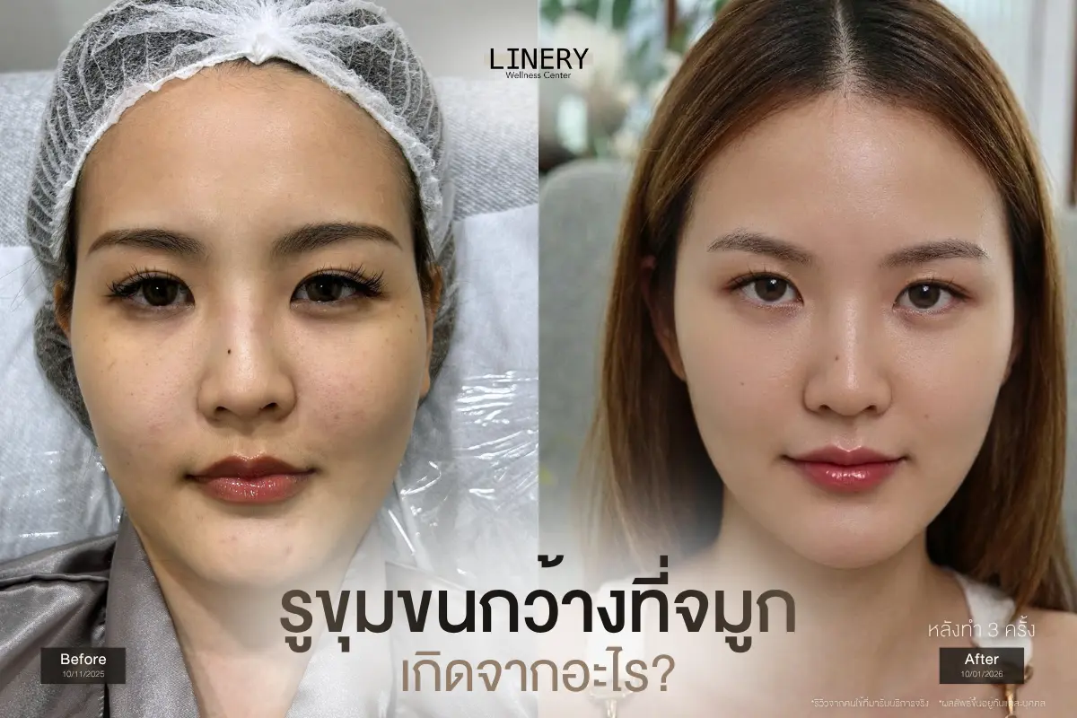 รูขุมขนกว้างที่จมูกเกิดจากอะไร