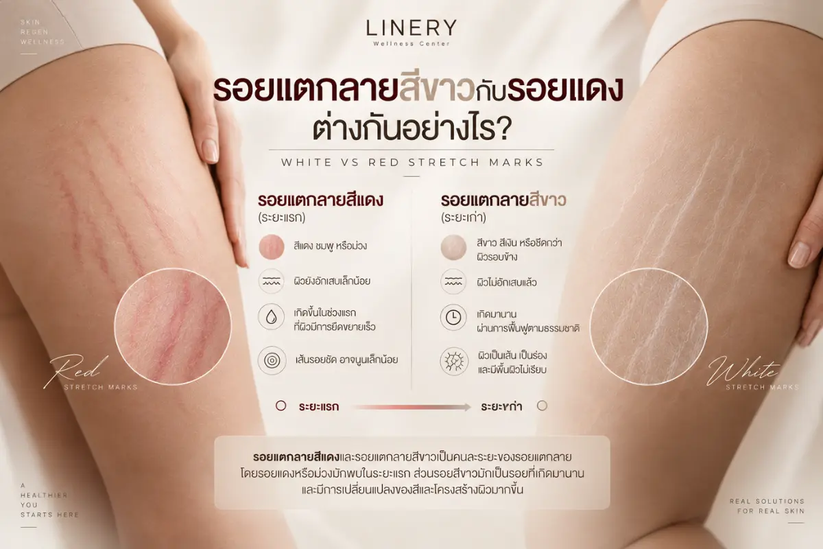 รอยแตกลายสีขาวกับรอยแดงต่างกันอย่างไร