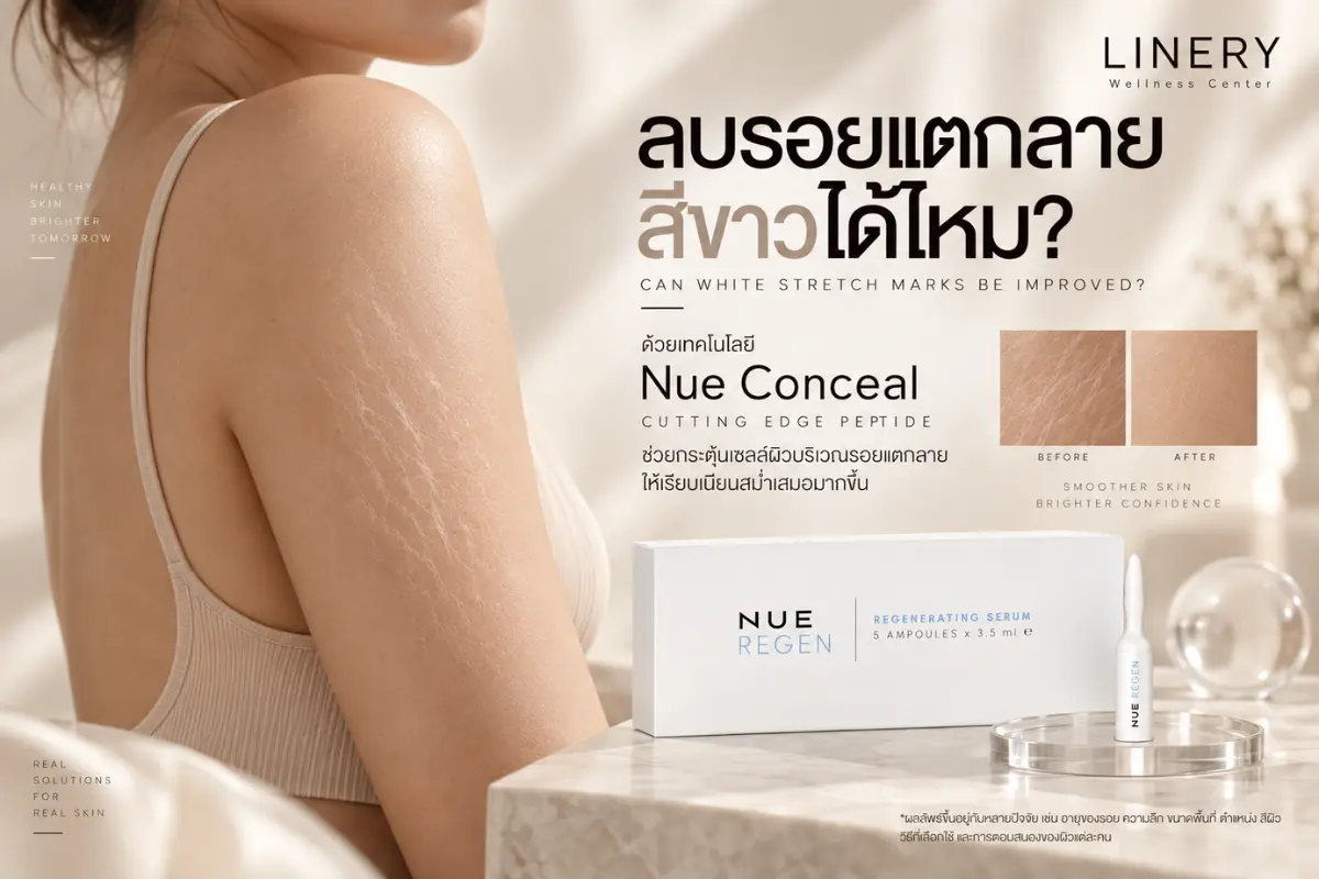 รอยแตกลายสีขาว รักษายังไง? มีวิธีอะไรบ้าง