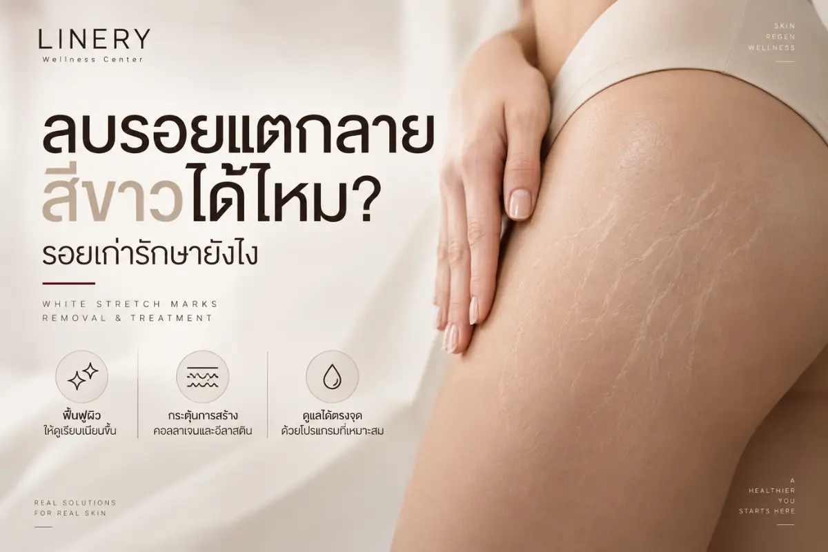 รอยแตกลายสีขาวแต่ละแบบ ควรประเมินอะไรบ้างก่อนเลือกวิธีรักษา