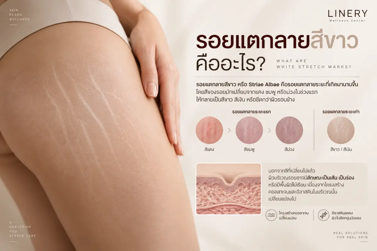 รอยแตกลายสีขาว คืออะไร