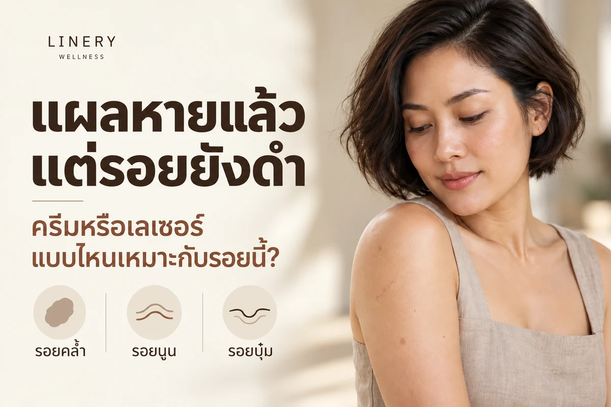 ภาพประกอบผู้หญิงมองรอยแผลที่หายแล้วบนต้นแขน พร้อมหัวข้อเรื่องรอยคล้ำ รอยนูน และรอยบุ๋ม